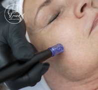 Micro-needlingÂ Treatments