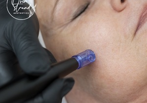 Micro-needlingÂ Treatments