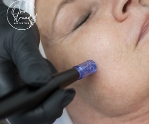 Micro-needlingÂ Treatments