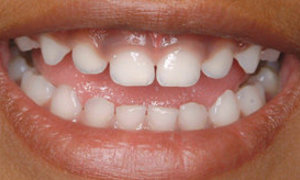 Protect Your Child's Teeth