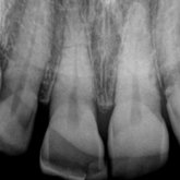 X-ray of tooth with fracture