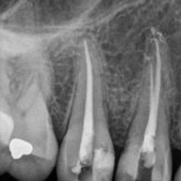 Root canal treatment completed