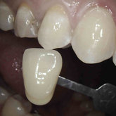 Taking the correct shade of the tooth
