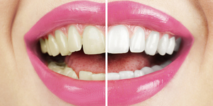 WHITENING