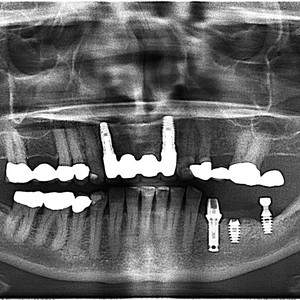 PAN showing crowns and bridges (white blobs) and implants (screws)