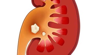 Hoe om nierstene uit te skei