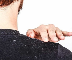 What really works on dandruff?