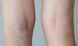 How to prevent varicose and spider veins