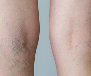 How to prevent varicose and spider veins