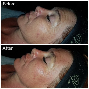 Napier - Eagles Rest Spa - Micro needling