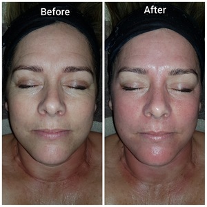 Napier - Eagles Rest Spa - Micro needling