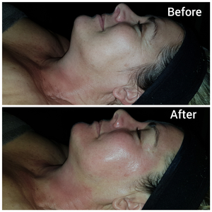 Napier - Eagles Rest Spa - Micro needling