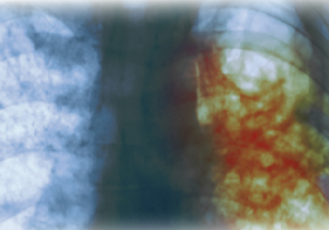 What To Do If You Have Been Exposed To TB