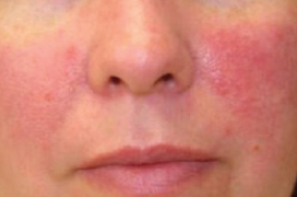 Does Coffee Influence the Risk of Rosacea?