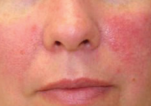 Does Coffee Influence the Risk of Rosacea?