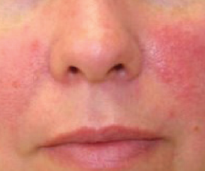 Does Coffee Influence the Risk of Rosacea?