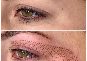 Plasma Pen Coming Soon!