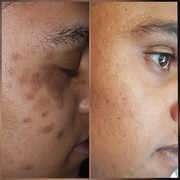 Skin Pigmentation