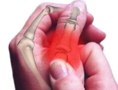 Voedsel wat met artritissimptome kan help